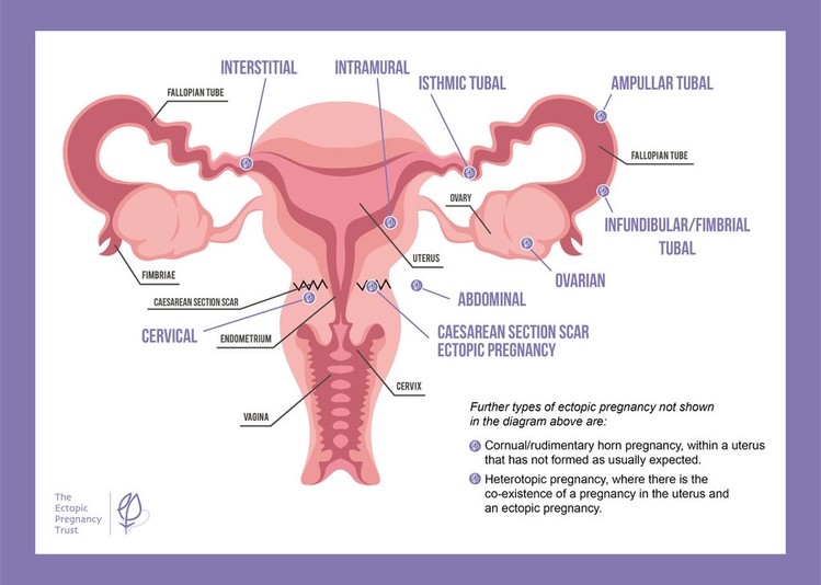Sites of an ectopic pregnancy
